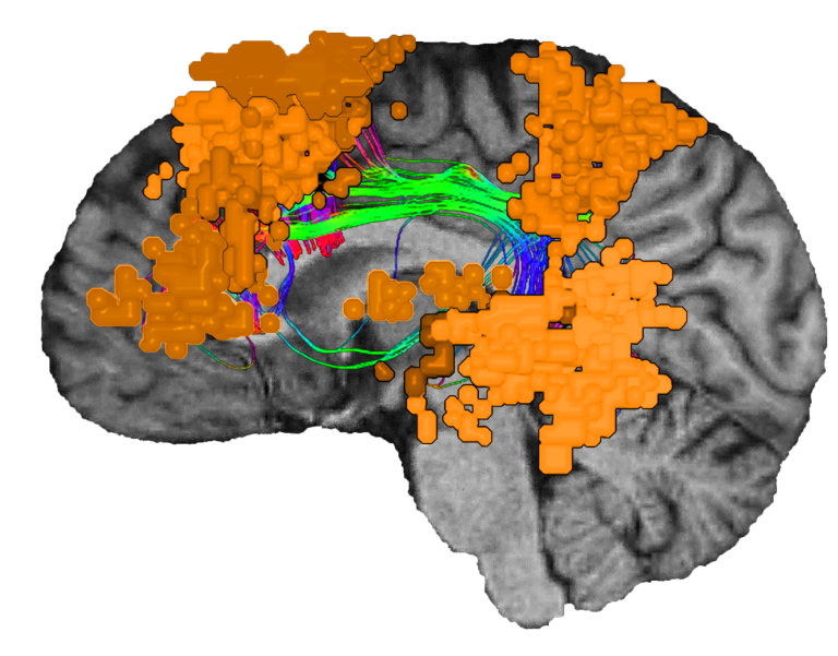 دربارۀ این مقاله بیشتر بخوانید When the Brain Can No Longer Speak: Understanding Aphasia and What It Reveals About Language