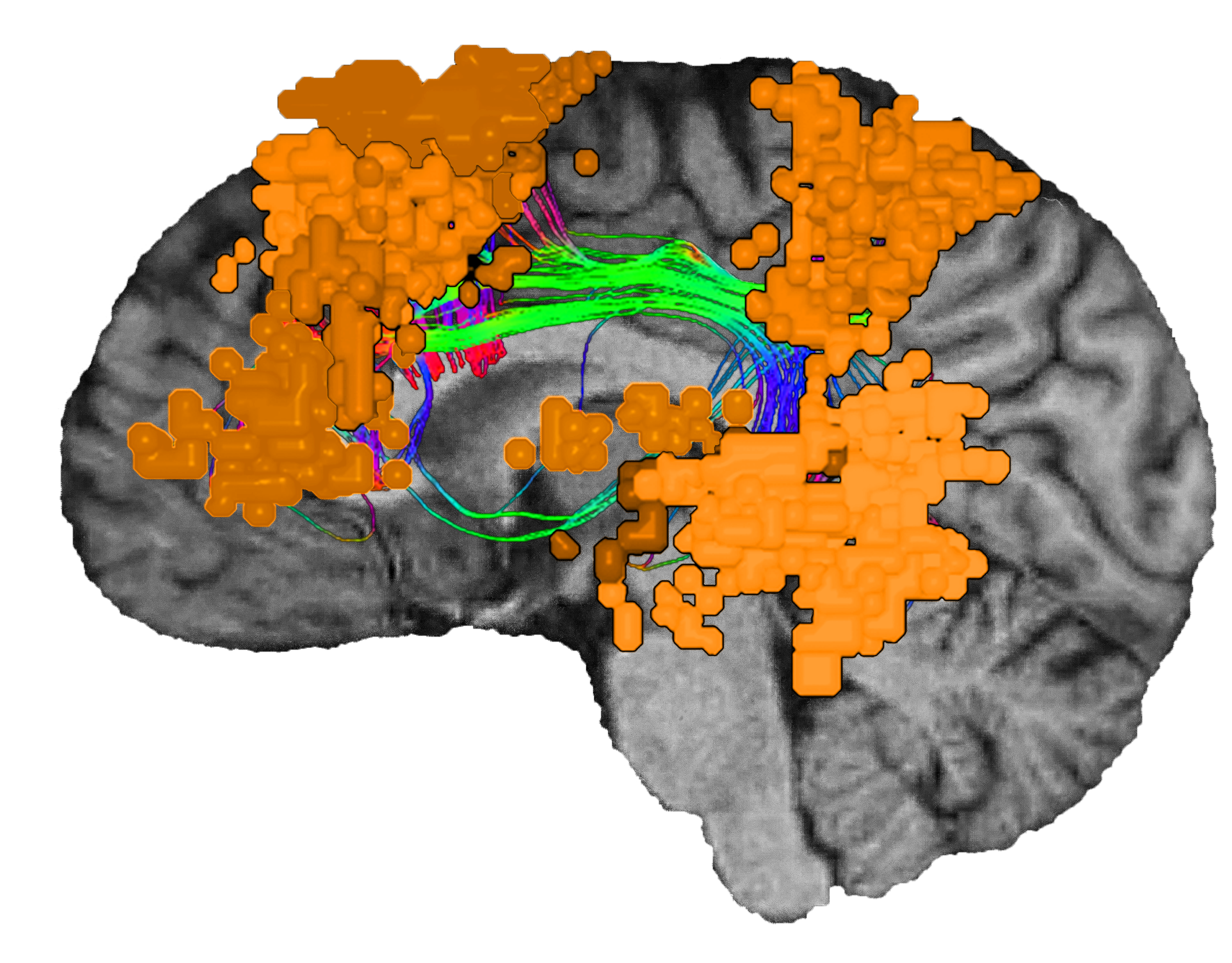 دربارۀ این مقاله بیشتر بخوانید When the Brain Can No Longer Speak: Understanding Aphasia and What It Reveals About Language